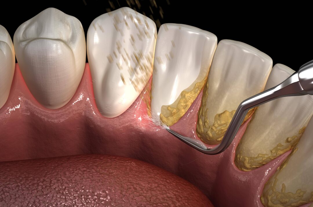 Scaling & Polishing . Sunshine Dental